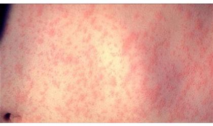 Finney County Confirms 6th Measles Case